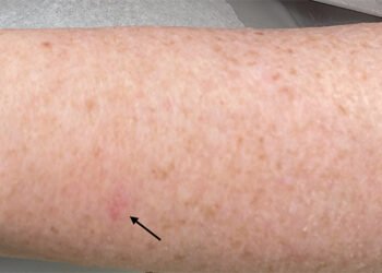 À quoi ressemble vraiment le cancer de la peau