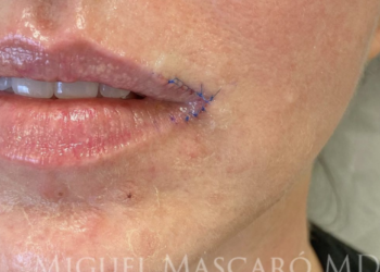 Ce que vous devez savoir sur le traitement tendance « Corner Lip Lift »