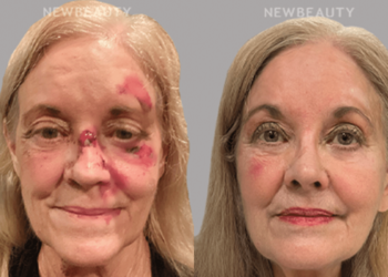 Cette ligne produit des avantages incroyables après un traumatisme facial ou une exposition aux radiations