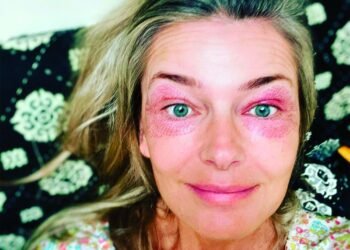 Tout ce qu'il faut savoir sur le resurfaçage de la peau au plasma