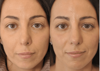 Aider!  Je déteste mon nouveau nez