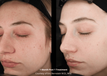 Ce nouveau traitement est-il le premier véritable « laser du midi ? »