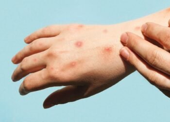 Monkeypox chez les enfants : ce que vous devez savoir