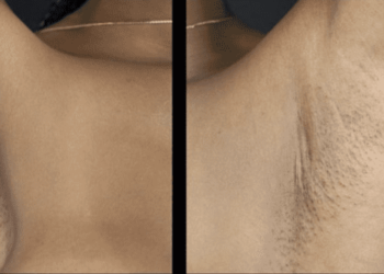 Cette technique de chirurgie mammaire ne promet aucune cicatrice visible