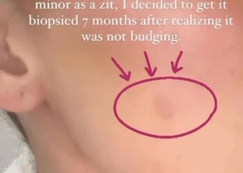 Khloé Kardashian a subi une intervention chirurgicale d'urgence pour retirer une tumeur "rare" de son visage