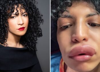 La réaction allergique de cette femme a été déclenchée par un baiser