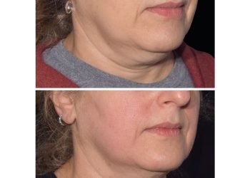 Pourquoi tout le monde essaie ce nouveau traitement sans aiguille