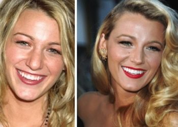 25 étoiles avant et après leur rhinoplastie !