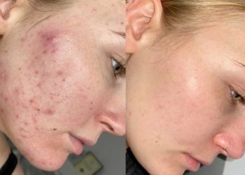 Cette barre nettoyante contre l'acné à 10 $ a été achetée 1 million de fois