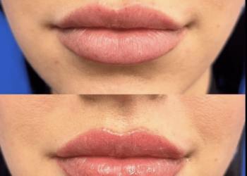 Le "Laser Lip FIip" est le nouveau moyen sans aiguille de repulper les lèvres fines