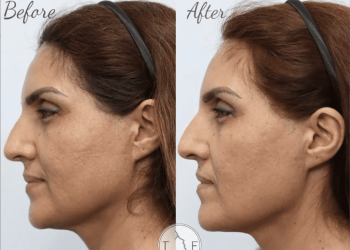 Le traitement Vivace Microneedling vient de recevoir une mise à niveau