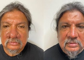 Les façons qui changent la vie des médecins traitent cette maladie rare du nez