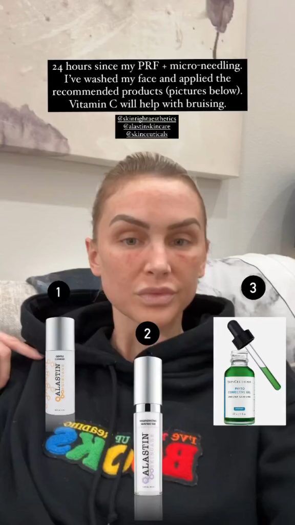 LaLa Kent partage des photos « après » meurtries de son alternative de remplissage sous les yeux