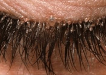 Elle n'a pas lavé sa taie d'oreiller depuis 5 ans... regardez ce qui lui est arrivé !