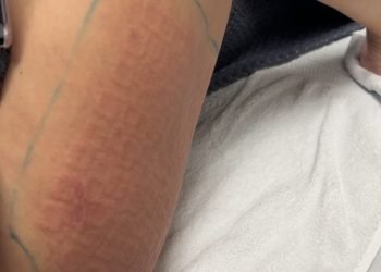 J'ai essayé le traitement corporel Morpheus8 et ce n'est pas une blague