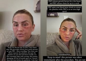 LaLa Kent partage des photos « après » meurtries de son alternative de remplissage sous les yeux