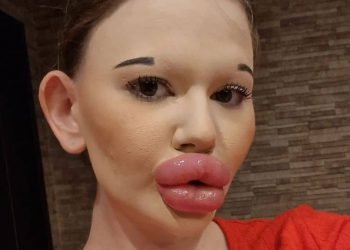 elle a reçu plus de 25 injections pour établir un nouveau record