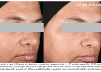 Ce sérum anti-taches éclaircit les marques post-acnéiques et le mélasma