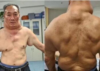 Il boit 1 litre d'alcool par jour depuis qu'il a 13 ans, voici le résultat sur son corps !