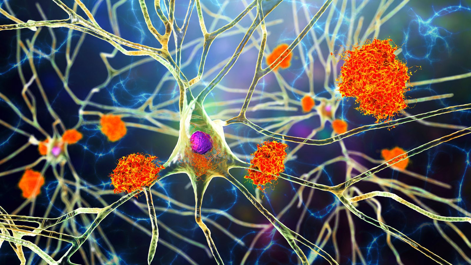 Illustration de plaques amyloïdes parmi les neurones et d'enchevêtrements neurofibrillaires à l'intérieur des neurones.