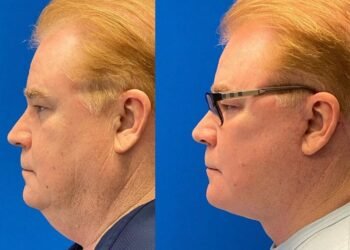 4 différences entre les liftings masculins et féminins