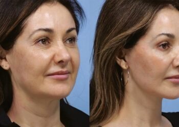 5 raisons pour lesquelles les experts disent qu'un lifting est incomplet sans lifting du cou