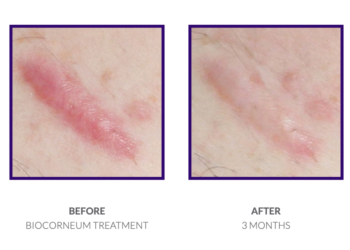 Ce gel transparent non collant rend les cicatrices tellement meilleures