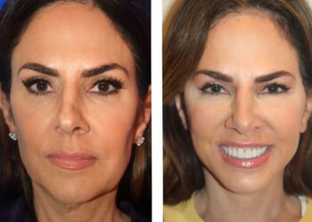 Jennifer Fessler de RHONJ parle d'un lifting naturel à 54 ans