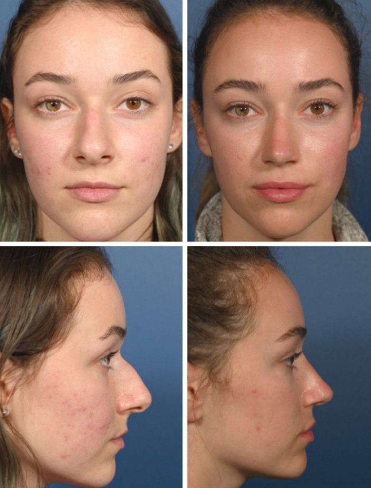 Cette rhinoplastie crée un profil plus droit sans changer votre visage – Thebuzzly