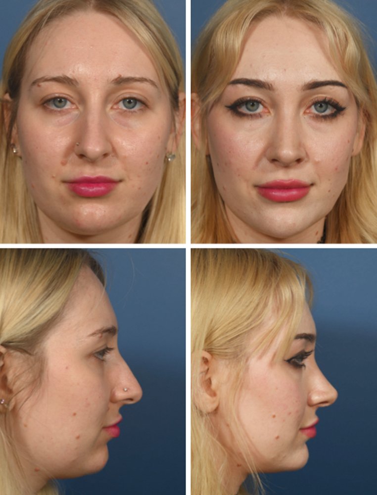 Cette rhinoplastie crée un profil plus droit sans changer votre visage – Thebuzzly