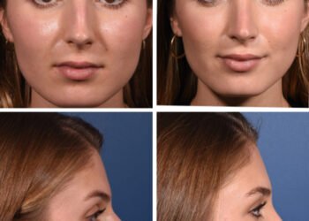 Cette rhinoplastie crée un profil plus droit sans changer votre visage