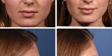 Cette rhinoplastie crée un profil plus droit sans changer votre visage