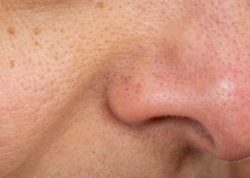 Comment se débarrasser des points noirs en toute sécurité selon les experts