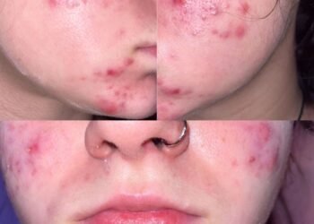 Je viens de terminer 6 mois sur Accutane - Voici ce que j'aurais aimé savoir avant