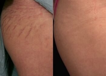 Les meilleurs traitements pour les vergetures, selon les dermes