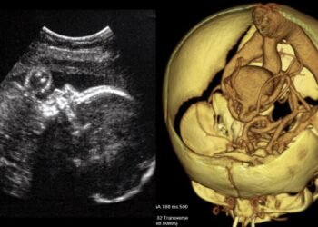 Des médecins pratiquent la première chirurgie cérébrale du genre sur un fœtus dans l'utérus