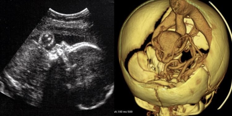 Des médecins pratiquent la première chirurgie cérébrale du genre sur un fœtus dans l'utérus – Thebuzzly