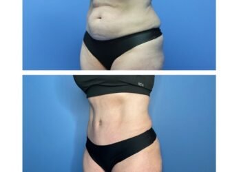 Un guide complet de la procédure