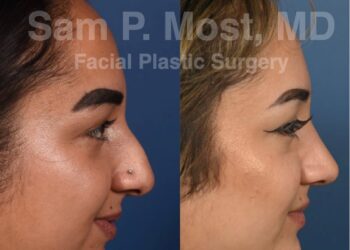 Types de rhinoplastie : un guide complet 2023