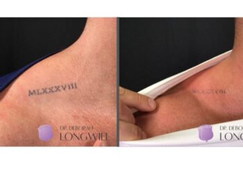 Un guide pour le détatouage au laser