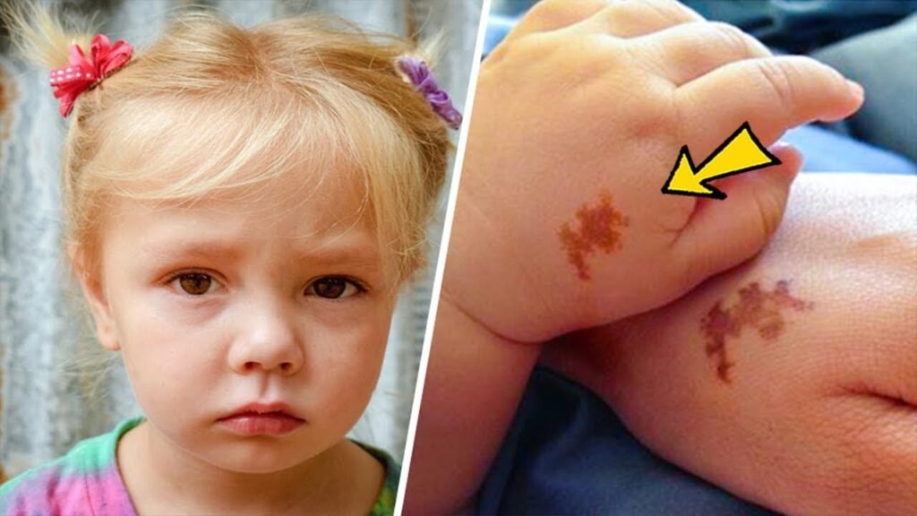 Mom adopts girl with same birthmark as her's, doing a test she was shocked Mom adopts girl with same birthmark as her's, doing a test she was shocked