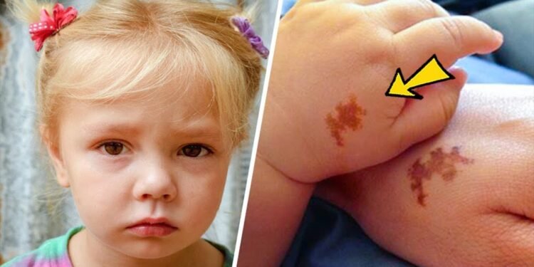 Mom adopts girl with same birthmark as her's, doing a test she was shocked – Thebuzzly