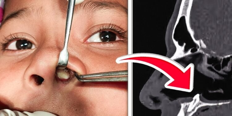 Doctors Found WHAT Growing Inside his NOSE! – Thebuzzly