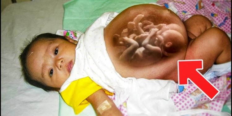 Baby Girl Born Pregnant with Twins and doctors were left speechless! – Thebuzzly