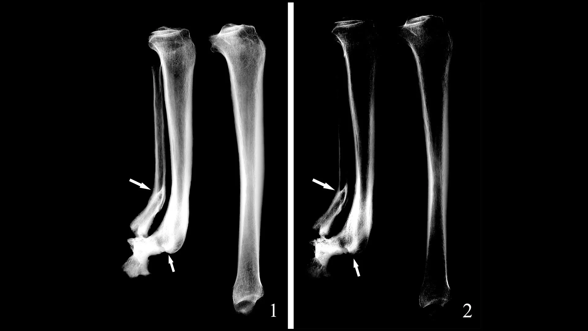 Deux radiographies côte à côte montrant les tibias gauche et droit d'une femme de 30 à 35 ans décédée il y a environ 3000 ans en Chine.  Le tibia inférieur droit a été amputé et la radiographie montre des dommages ici.