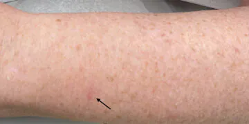 À quoi ressemble vraiment le cancer de la peau