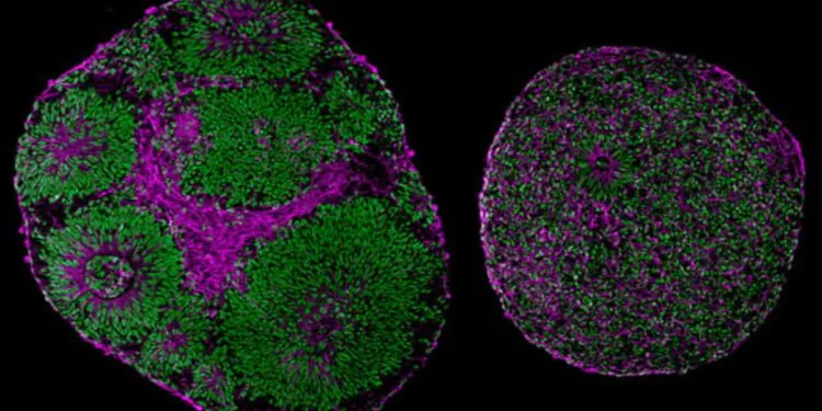 Autism-Linked Gene Mutation Reversed Using Lab-Grown Brain Experiment