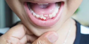 Qu'est-ce qui cause le saignement des gencives?  |  Sciences en direct