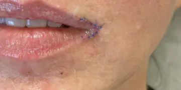 Ce que vous devez savoir sur le traitement tendance « Corner Lip Lift »