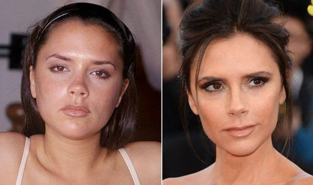 7 casos exitosos de cirugías plasticas de celebridades